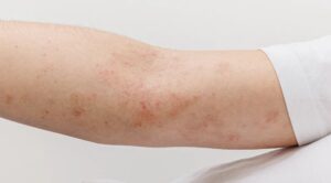 omega 3 piel atopica