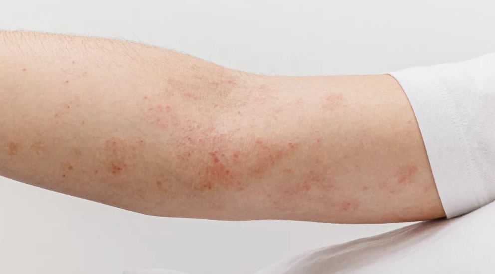 omega 3 piel atopica